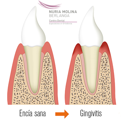 gingivitis-o-enc-as-inflamadas-centre-dental-nuria-molina-berlanga